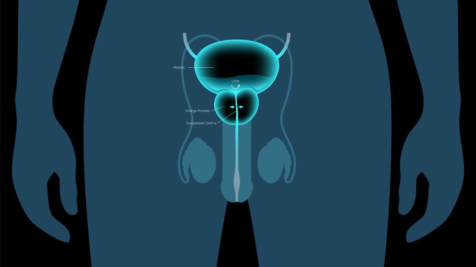 전립선비대증,전립선비대증증상,전립선비대증치료,전립선비대증주의사항,전립선비대증진료,전립선비대증정의,전립선비대증수술,전립선비대증치료법,전립선비대증치료방법