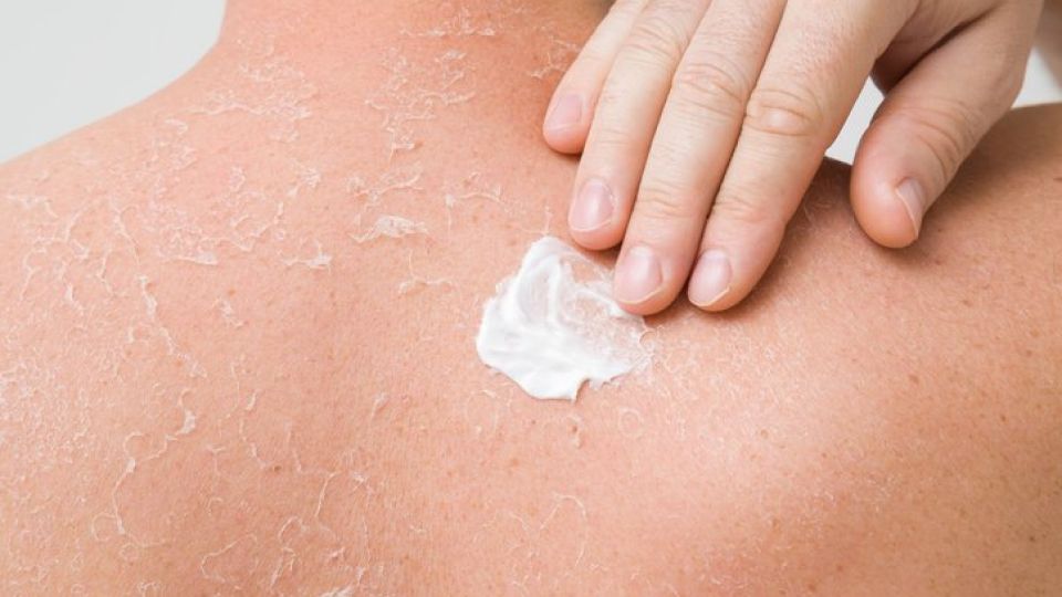 햇빛, 햇빛알레르기, 알레르기, 발진, 가려움증, 비타민D, 나만의닥터, 비대면진료