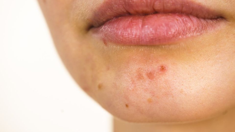 여드름약, 화농성여드름, 로아큐탄, 이소티논, 미노씬, 여드름관리, 여드름치료, 여드름흉터, 여드름, 여드름피부