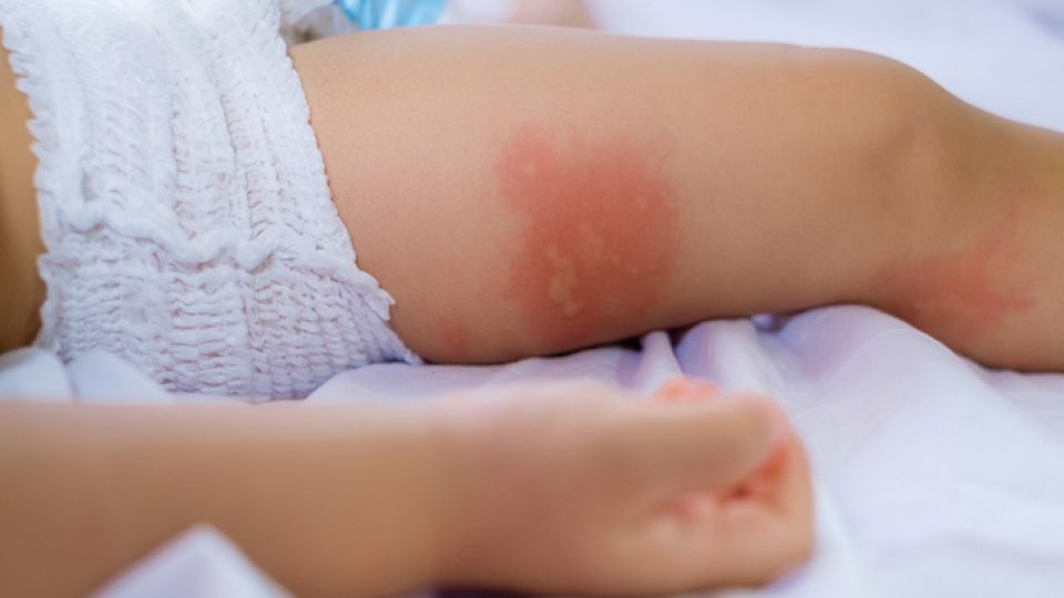 태열,소아아토피,아토피피부염,소아태열,신생아,아토피질환,아토피보습제,아토피치료,태열치료