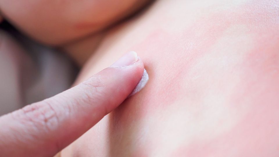 나만의닥터, 비대면진료, 스키터증후군, 모기약, 벌레물렸을때, 모기물렸을때응급처치법, 모기물린후, 모기물려가려운데, 모기물렸을때침, 리도맥스연고