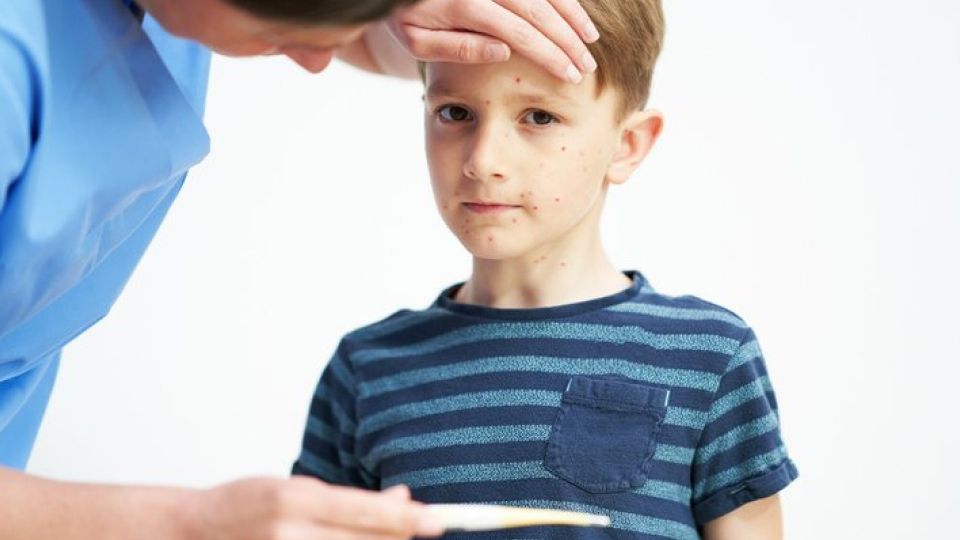 수두, 수두대상포진, 수두대상포진차이, 대상포진, 수두치료, 수두증상, 수두원인, 성인수두