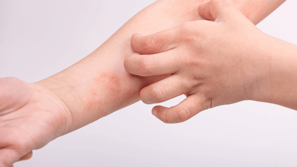 두드러기약 처방