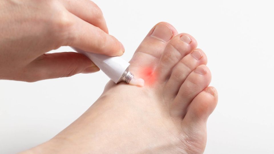 나만의닥터, 비대면진료, 발톱무좀, 페디큐어무좀, 발톱무좀원인, 발톱무좀치료, 발톱무좀약, 발톱무좀진료, 주블리아, 발톱무좀예방