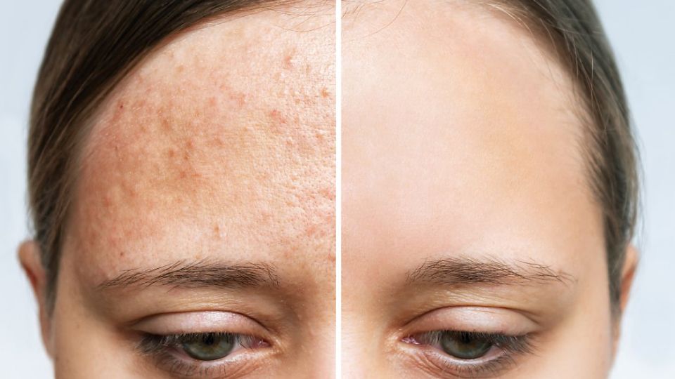 여드름약, 화농성여드름, 로아큐탄, 이소티논, 미노씬, 여드름관리, 여드름치료, 여드름흉터, 여드름, 여드름피부