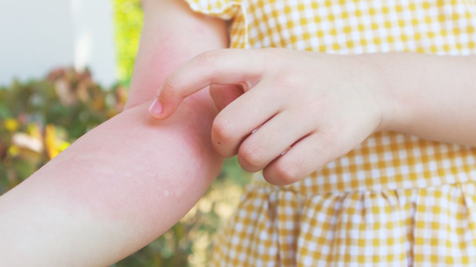 나만의닥터, 비대면진료, 피부묘기증, 피부묘기증원인, 피부묘기증증상, 피부묘기증치료, 피부묘기증예방, 피부묘기증진료, 단순피부묘기증, 피부묘기증피부과, 증상성피부묘기증