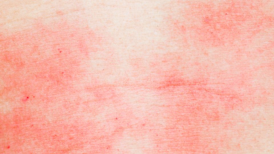 완선,백선,고부백선,피부사상균,무좀연고,플루코나졸,완선연고