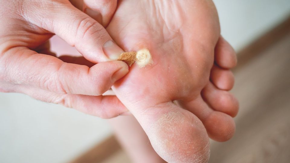 나만의닥터, 비대면진료, 티눈, 티눈증상, 티눈원인, 티눈치료, 사마귀, 사마귀원인, 사마귀증상, 사마귀치료, 티눈과사마귀