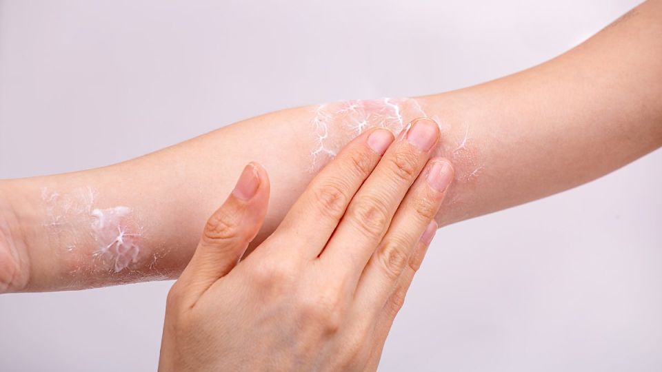 나만의닥터, 비대면진료, 땀띠, 땀띠예방, 땀띠치료, 땀띠예방법, 땀띠났을때, 땀띠원인, 소아땀띠, 성인땀띠, 성인땀띠치료