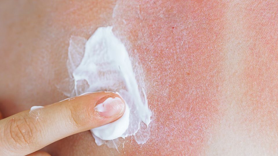 나만의닥터, 비대면진료, 화상, 화상치료, 고데기, 화상증상, 화상단계별치료, 화상응급처치, 1도화상, 2도화상, 3도화상