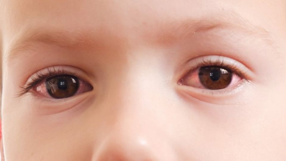 여름철눈병,여름유행성안질환,유행성결막염,유행성각결막염,급성출혈성결막염,인후결막염,여름눈병예방,여름눈병