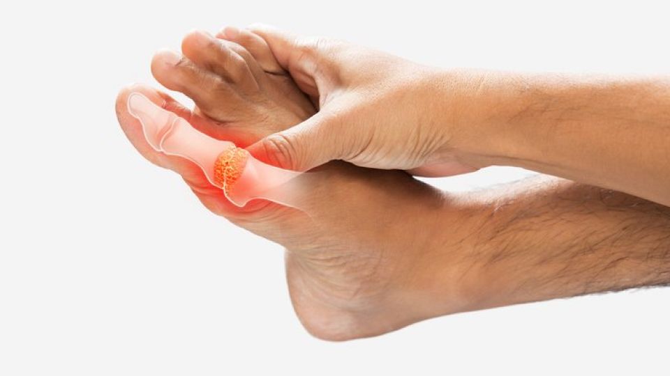 통풍,통풍치료,통풍증상,통풍초기증상,통풍치료법,통풍원인