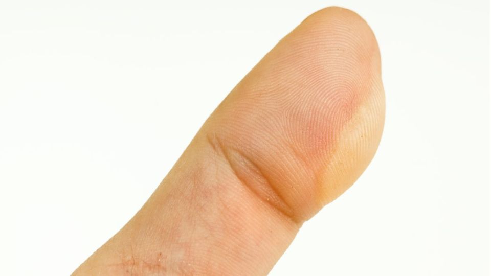 나만의닥터, 비대면진료, 화상, 화상치료, 고데기, 화상증상, 화상단계별치료, 화상응급처치, 1도화상, 2도화상, 3도화상