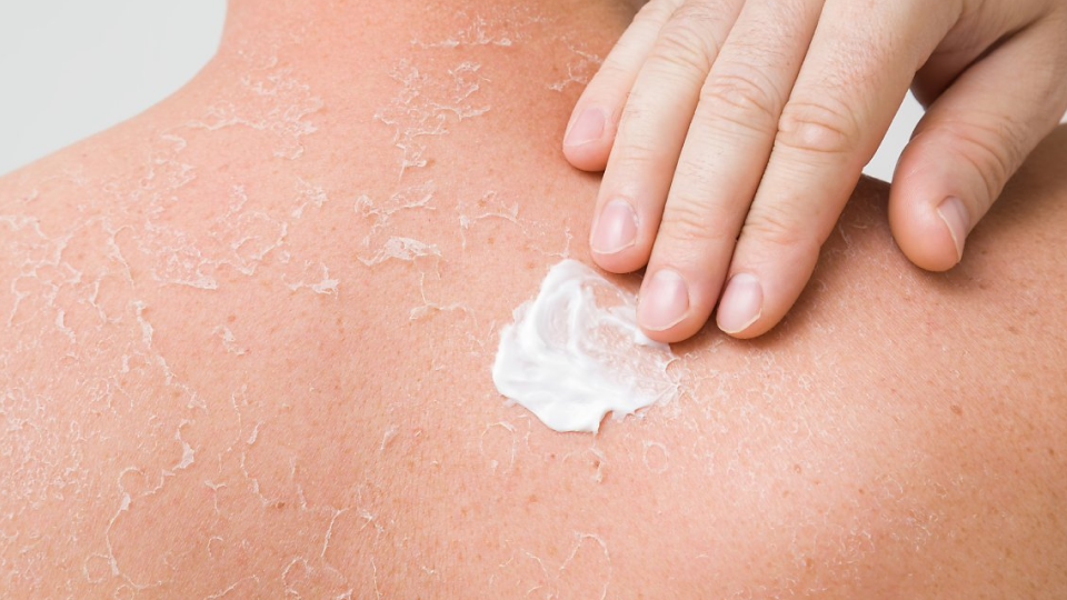 아토피, 피부염, 치료, 연고, 아토피약