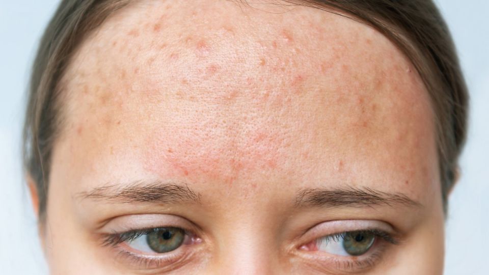 다낭성난소증후군, 생리불순, 무월경, 여드름, 무모증, 탈모증, 비만, 체중증가, 다낭성난소