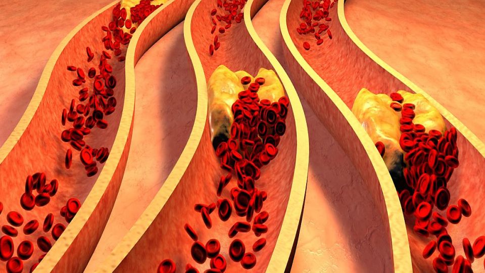 고지혈증, 고지혈증증상, 콜레스테롤, 고지혈증치료, 고지혈증진료, 고지혈증원인, 고지혈증초기증상, 콜레스테롤낮추는방법