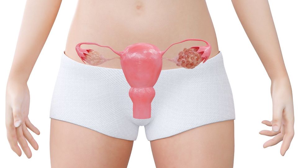 다낭성난소증후군, 생리불순, 무월경, 여드름, 무모증, 탈모증, 비만, 체중증가, 다낭성난소