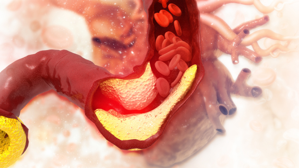 고지혈증에 좋은 음식 및 영양제