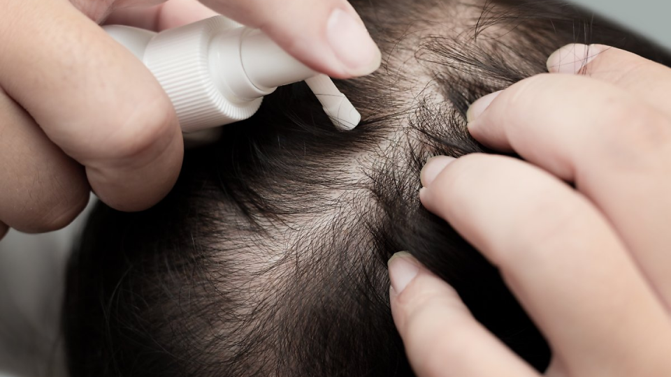 탈모, 탈모약, 효과, 카피약, 오리지널약