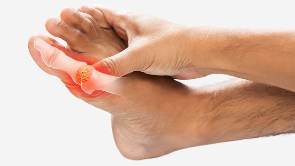 통풍, 통풍증상, 통풍치료, 통풍예방, 통풍가족력, 통풍치맥, 통풍초기증상, 통풍초기