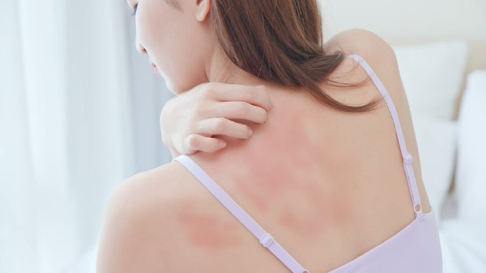 이소티논, 여드름, 이소트레티노인, 로아큐탄, 효과