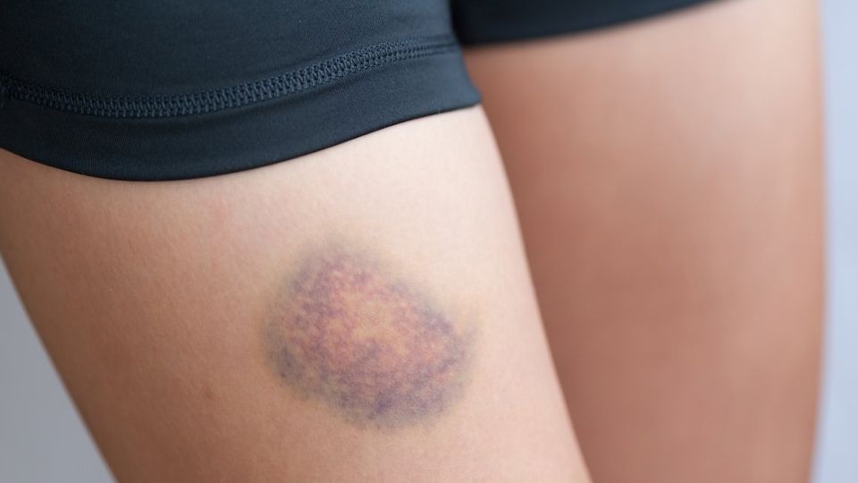 다이어트주사, 다이어트주사제, 지방분해주사, 지방흡입주사, 지방흡입주사효과, 지방분해주사효과