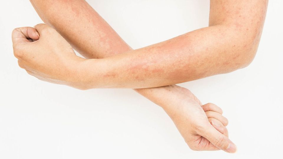 아토피, 아토피치료, 아토피초기, 아토피로션, 성인아토피, 아토피병원, 아토피원인, 아토피관리, 아토피증상