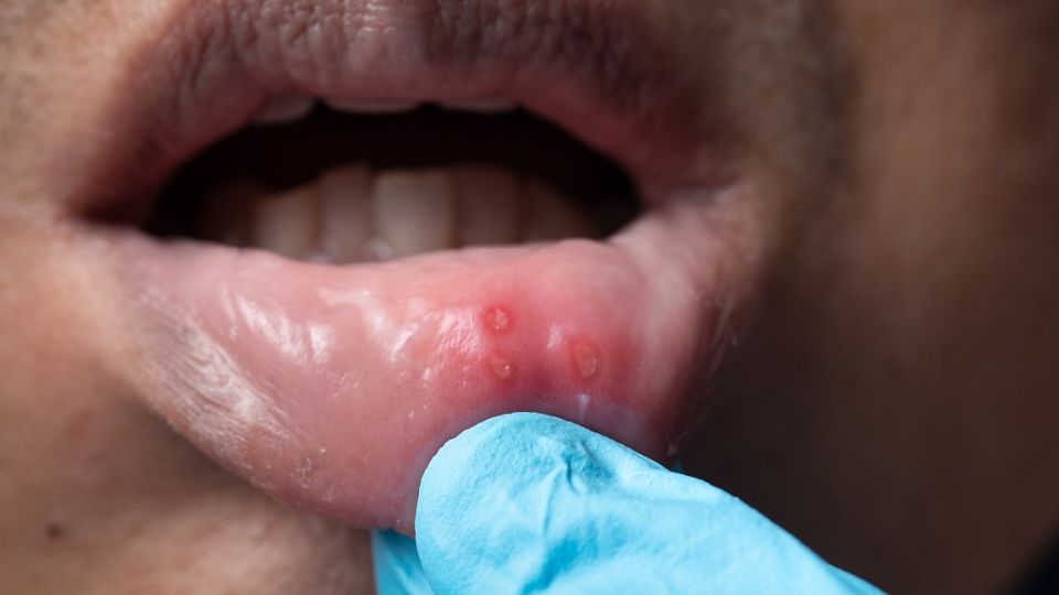 환절기, 환절기질환, 안구건조증, 안구건조증예방, 안구건조증증상, 비염, 환절기비염, 환절기결막염