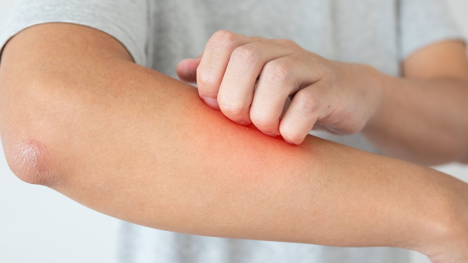 아토피, 피부염, 치료, 연고, 아토피약