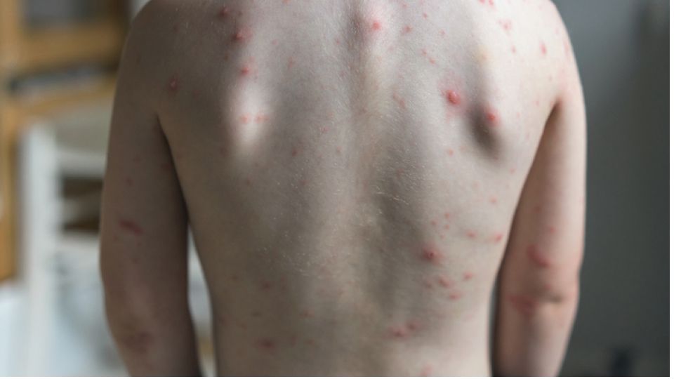 녹농균이 일으키는 질병.jpg