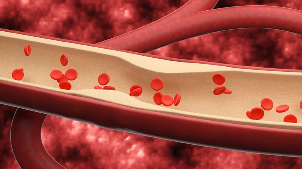 치매, 치매 정의, 치매 원인, 치매 종류, 치매 증상, 치매 질환, 알츠하이머병, 혈관성 치매, 루이소체치매 
