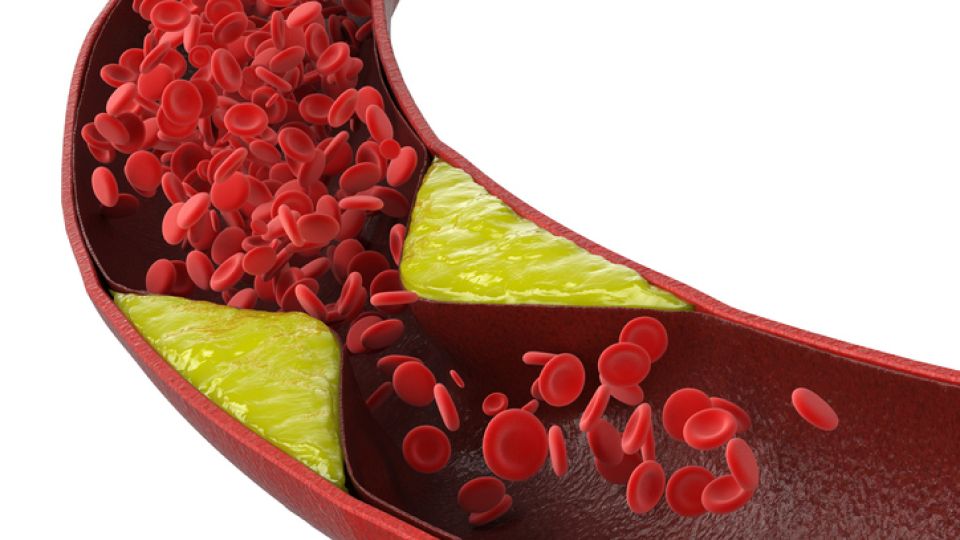 고지혈증, 고지혈증에좋은음식, 고지혈증영양제, 고지혈증에좋은영양제, 고지혈증식이요법, 고지혈증식단
