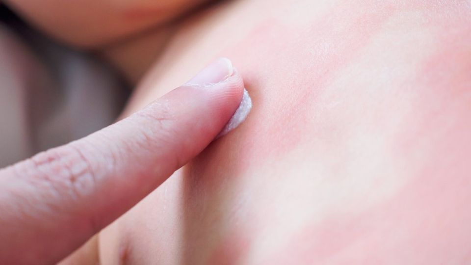 아토피, 아토피치료, 아토피초기, 아토피로션, 성인아토피, 아토피병원, 아토피원인, 아토피관리, 아토피증상