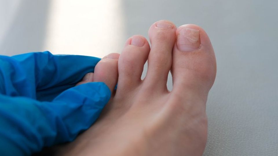 나만의닥터, 비대면진료, 발톱무좀, 페디큐어무좀, 발톱무좀원인, 발톱무좀치료, 발톱무좀약, 발톱무좀진료, 주블리아, 발톱무좀예방