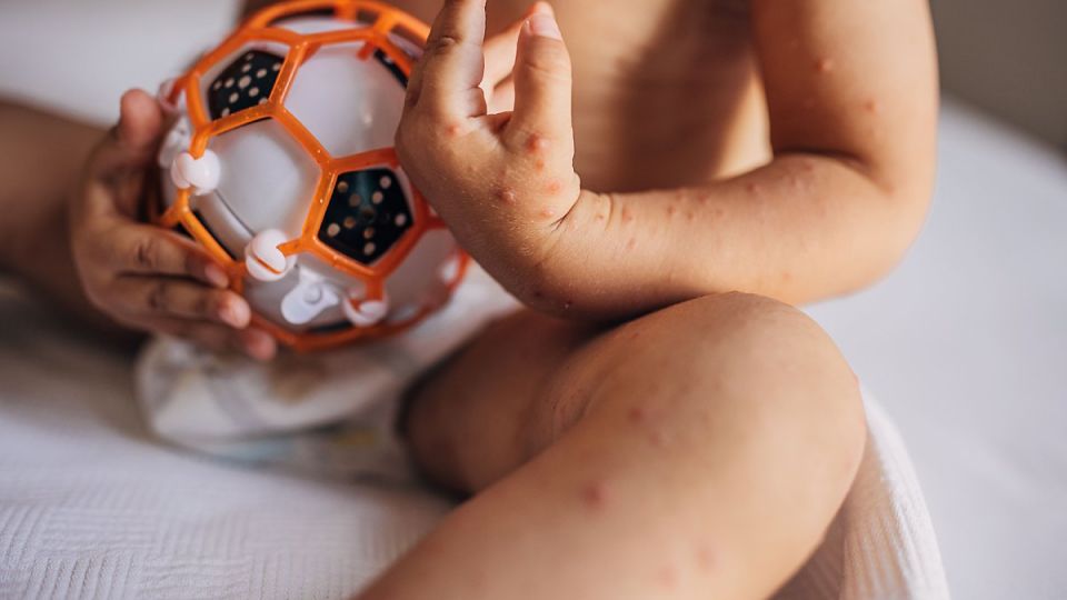 나만의닥터, 비대면진료, 소아과, 소아과오픈런, 아데노바이러스, 알레르기,수족구병