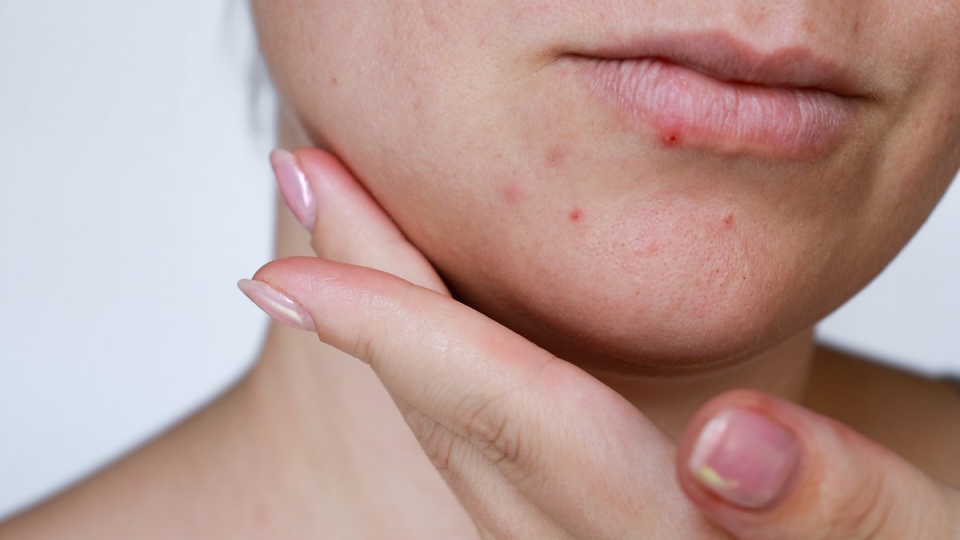 크레오신티, 여드름, 여드름약, 모공, 부작용