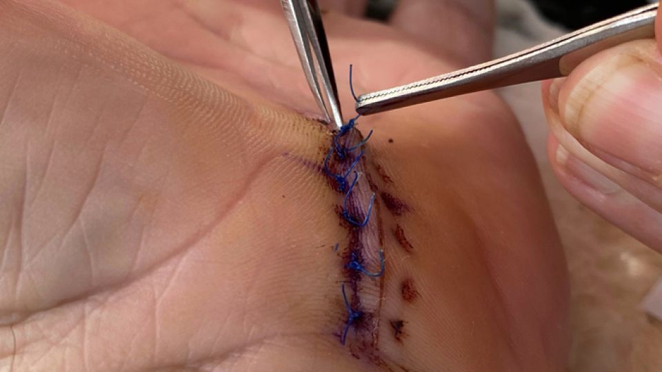 상처, 흉터, 후시딘, 마데카솔, 지혈