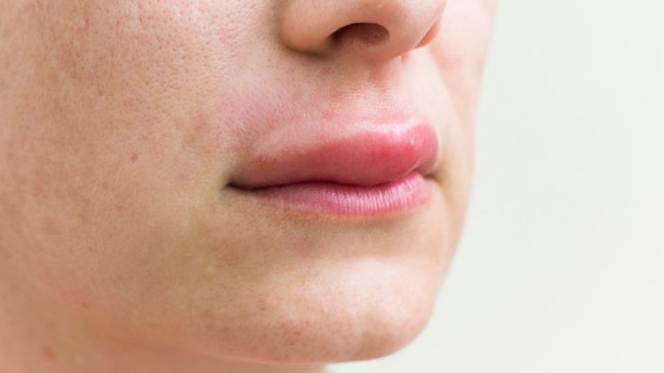 아나필락시스, 아나필락시스쇼크, 아나필락시스증상, 아나필락시스원인, 아나필락시스대처법, 아나필락시스위험성, 아나필락시스사망, 아나필락시스치료