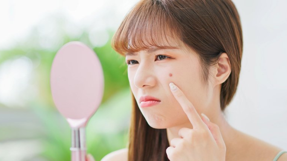 이소티논, 여드름, 이소트레티노인, 로아큐탄, 효과