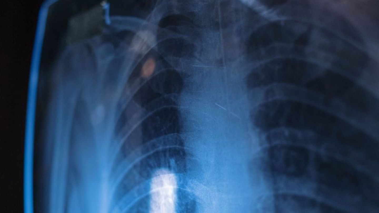흉부 X-ray 검사를 받는 환자