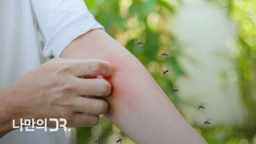스키터 증후군은 면역력이 약한 어린 아이에게서 많이 발생하는 모기 알레르기이다.