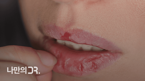 입술을 뜯거나 침을 자주 바르는 행위는 구순염을 악화시킬 수 있다.