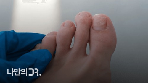 쪼리를 자주 신으면 족저근막염의 위험이 높아질 수 있다.