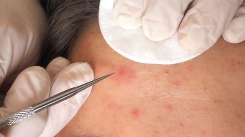 좁쌀 여드름에는 각질용해제가 치료약으로 쓰인다.