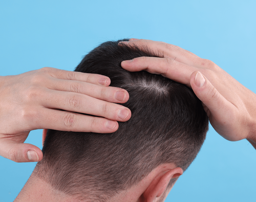 지루성 탈모는 두피 건강이 악화되면서 정수리 부위에서 탈모가 발생하는 유형이다.