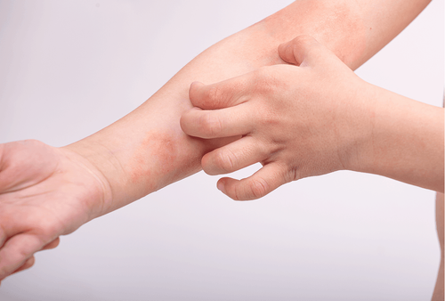 동전습진은 경계가 잘 구분되는 동그란 모양의 습진성 판이 피부에 나타나는 질환이다.