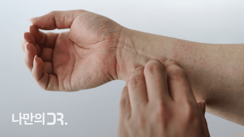 건선은 면역체계의 이상으로 발생한 염증이 유전적, 환경적 요인으로 악화되어 발생한다.