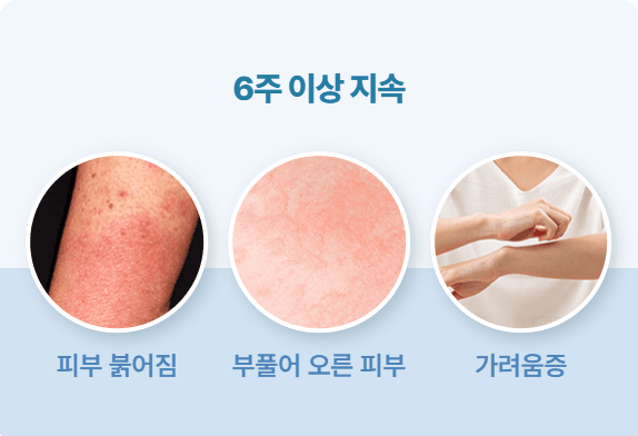 만성두드러기 인포그래픽