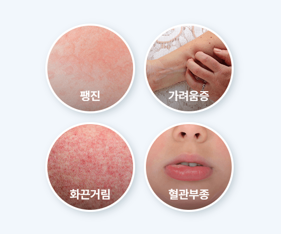 만성두드러기 인포그래픽