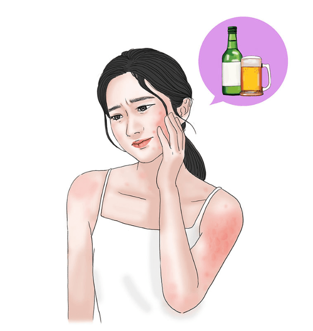 만성두드러기 인포그래픽